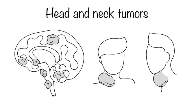Head and neck tumors - Powered by Adobe