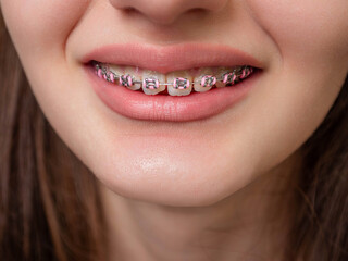 A girl with braces on her teeth is smiling. The braces are pink and have a pink and white design with some decorative glamour elements. Health care concept. Very expensive procedure