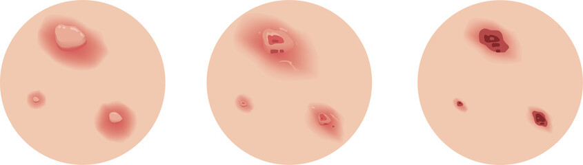 Chickenpox of Stage on Skin