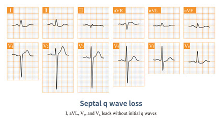 Septal q wave loss refers to the initial q wave loss of leads I, aVL, V5, and V6, which can be partially or completely lost.