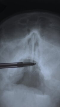 Doctor learning vertical X-ray scan of skull facial asymmetry. Head with deviated nasal septum. 4k footage.