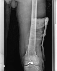 Knee Joint X-ray Showing Bone Fracture