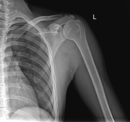 Shoulder Joint X-ray in AP View