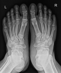 X-ray of Bilateral Feet in AP View