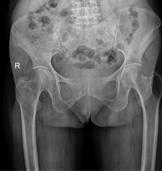 Pelvic Bone Structure X-ray of a Female