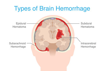 Types Brain hemorrhage inside skull of including Epidural hemorrhage, Subdural , Subarachnoid, and Intraparenchymal. Anatomy of human brain hemorrhage.