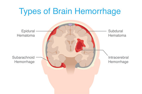 Types Brain hemorrhage inside skull of including Epidural hemorrhage, Subdural , Subarachnoid, and Intraparenchymal. Anatomy of human brain hemorrhage.