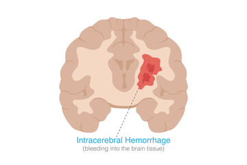 Section of brain with bleeding into brain tissue make damage or disorder. Medical called Intracerebral hemorrhage or ICH. Human head injury.