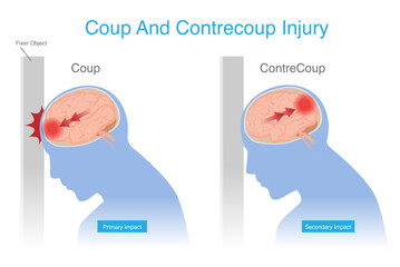Contrecoup and Coup Injury is brain injury after head strikes an object make damage area directly point and opposite side of human brain.