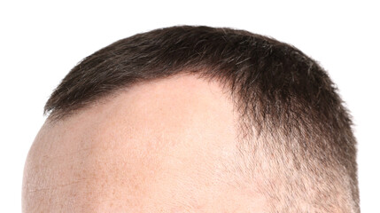 Obraz premium Baldness problem. Man with receding hairline on white background, closeup