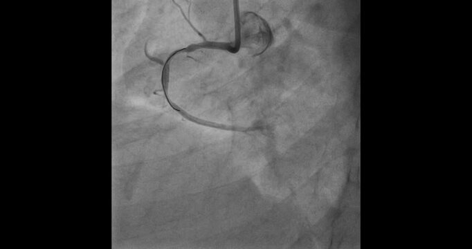 Right Coronary Artery Lesion Successfully Crossed with Guidewire: Clinical Imaging and Intervention