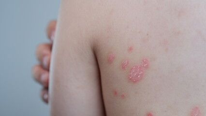Fototapeta premium Small patches of Psoriasis in a man's back. Skin with psoriasis.