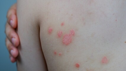 Small patches of Psoriasis in a man's back. Skin with psoriasis.