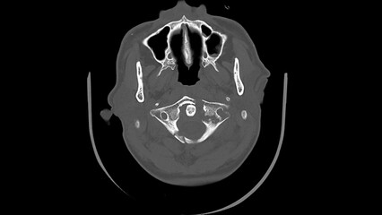A Jefferson fracture&nbsp; ct scan image ,cervical fracture ,The cervical spine images 
