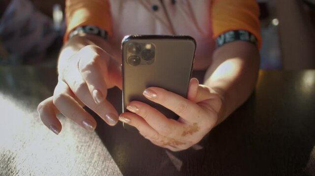 Hands of a woman with vitiligo on her skin are using a smartphone. Fingers with patchy of the pigmented girl are holding the phone. Female with melanin deficiency, autoimmune disease, dermatology