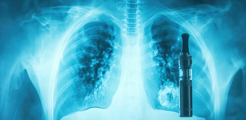 An X-ray presents the lungs showing signs of damage associated with vaping, alongside a vaping device. This highlights the health risks linked to e-cigarette use.