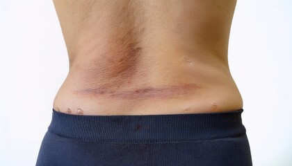 Naklejka premium close-up of a scar on the lower back caused by falling off a tree, showcasing uneven texture and healing marks in isolated white background 