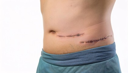 close-up of a surgical scar from an emergency abdominal procedure with faint and clean healing in isolated white background
