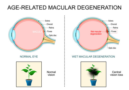 Wet Age-related Macular Degeneration AMD