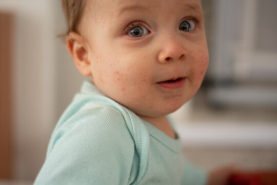 9-month-old baby with skin rash
