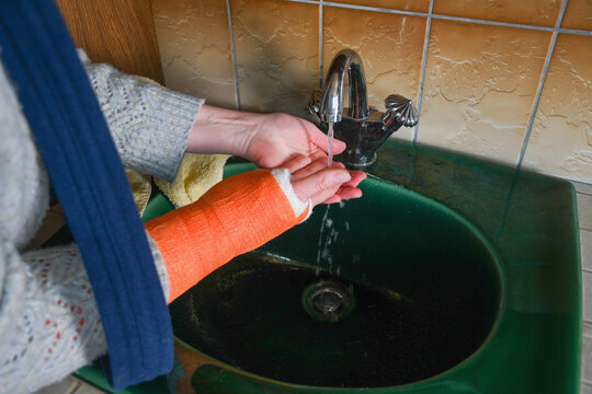 woman washes her right hand, which is in a cast, under running water with her left hand, washing off peeling skin, concept of care after injury, - Powered by Adobe