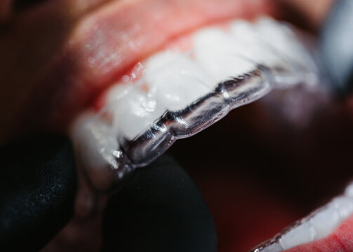 Los dientes superiores con alienadores invisibles 