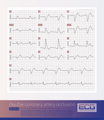 In the frontal plane lead system, when the initial vector of the QRS wave is directed downward, the positive initial QRS wave is recorded in leads II, III, and aVF.
