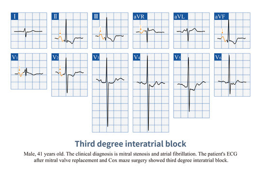 When Bachmann bundle conduction is interrupted, the right atrium excites the left atrium through the coronary sinus, producing positive and negative biphasic P-waves in the inferior leads.