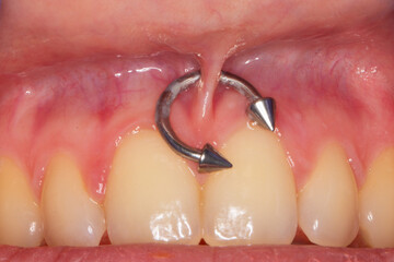 Trauma to the gums due to oral piercing