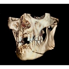 3d reconstruction computer tomography or CT scan image showing severe fracture of the face after an accident. Teeth and mandible fracture.