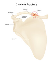 Causes and Symptoms of Clavicle Fracture