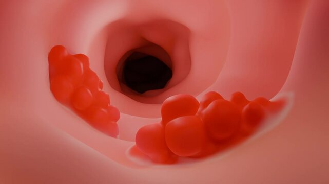 Colon cancer is a type of cancer that begins in the large intestine (colon). It often starts as small, non-cancerous clumps of cells called polyps, that can form on the inner lining of the colon