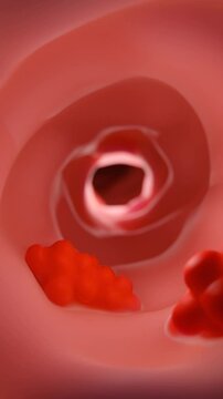 Colon cancer is a type of cancer that begins in the large intestine (colon). It often starts as small, non-cancerous clumps of cells called polyps, that can form on the inner lining of the colon