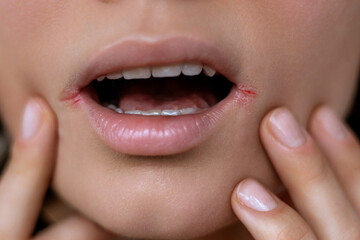 Close up of woman having problem with mouth disease, dry skin on corner of chapped lips with visible irritation or angular cheilitis, cracks, visible irritation in the corners of the mouth, redness