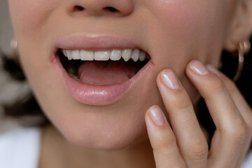 Close up of woman having problem with mouth disease, dry skin on corner of chapped lips with...