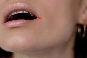 Close up of woman having problem with mouth disease, dry skin on corner of chapped lips with...