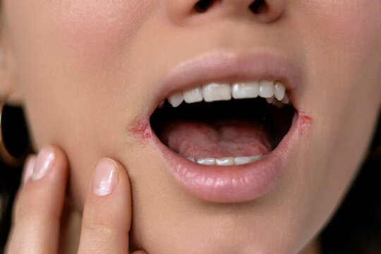 Close up of woman having problem with mouth disease, dry skin on corner of chapped lips with visible irritation or angular cheilitis, cracks, visible irritation in the corners of the mouth, redness