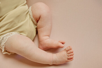 Baby legs with dry skin in beige romper on soft background