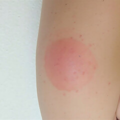 Fototapeta premium Safe and Effective Ligelizumab Treatment for Chronic Spontaneous Urticaria