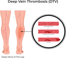 Deep Vein Thrombosis Design Vector Illustration