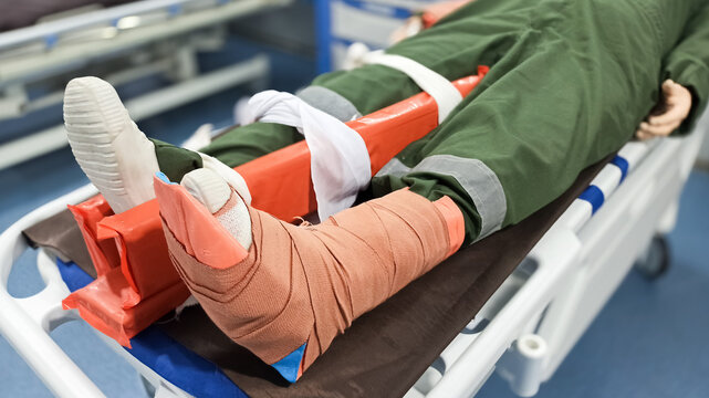 splinting a patient's leg with a broken leg using a wooden splint