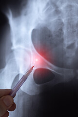 Doctor learn vertical X-ray image of big hernia in pelvic spine. Orthopedic treatment. Diagnostic, human health care.