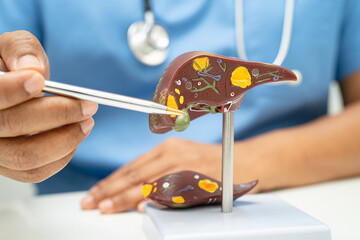 Cirrhosis, Liver cancer, fatty liver, Asian doctor with liver human anatomy model in World Hepatitis Day at hospital.