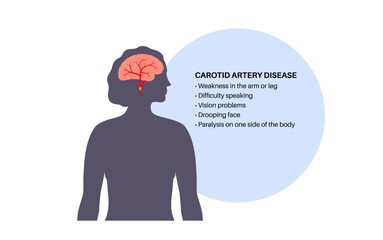 Carotid artery disease