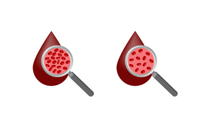 Iron deficiency anemia. Normal blood and anemia. Blood droplet. Blood donation. Realistic vector 3d picture. Vector illustration isolated on white background.