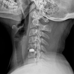 Neck X-ray of a patient undergoing Cervical Microdiscectomy and Cervical Disc Prosthesis for Medical Research and Teaching. Vector illustration.
