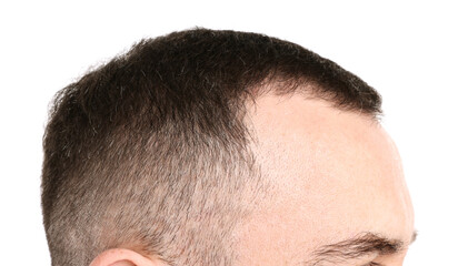 Obraz premium Baldness problem. Man with receding hairline on white background, closeup