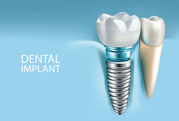 Dental implants on a light blue background, Vector illustration