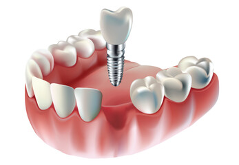 Tooth implant, tooth restoration, on white background, Vector illustration