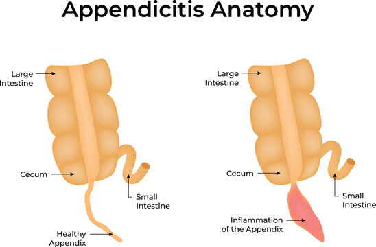 Appendicitis Anatomy Design Vector Illustration